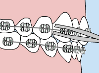 Dental Braces in Langford  Parkway Dental - Westshore